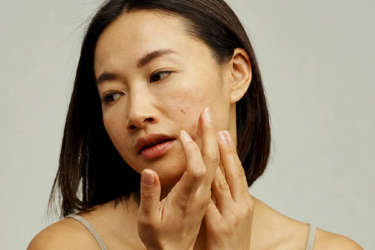 New Acne Treatments Filipino Dermatologists - I Am Nikki Tang
